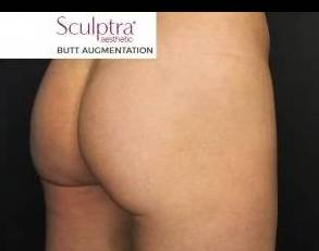 Sculptra (10 vials) Case 2 After