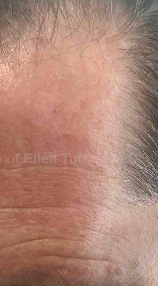 SRT-100 Before and After Case 18 After