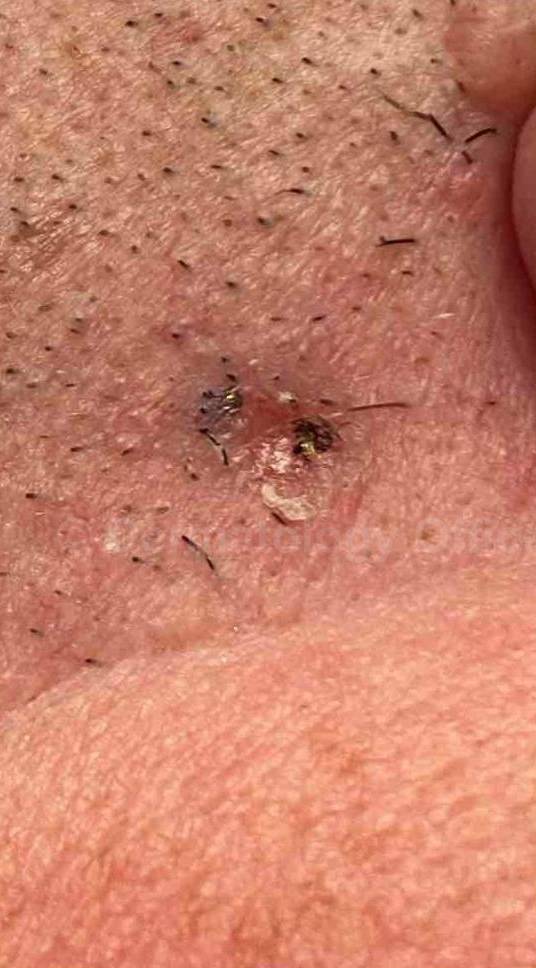 SRT-100 Before and After Case 19 Before