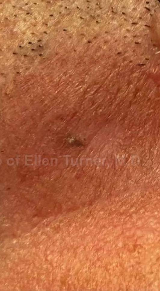 SRT-100 Before and After Case 19 After