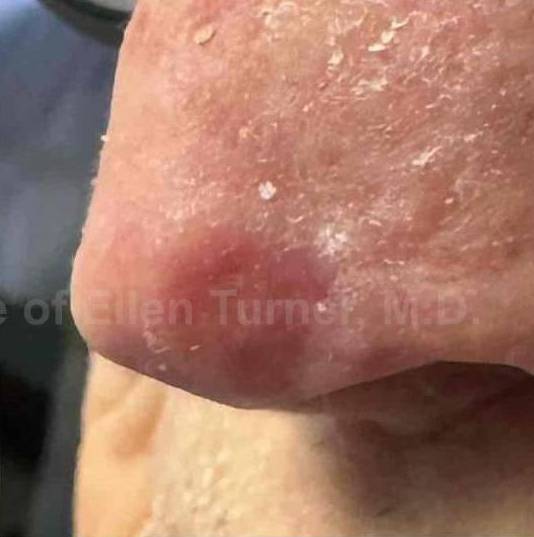 SRT-100 Before and After Case 20 After