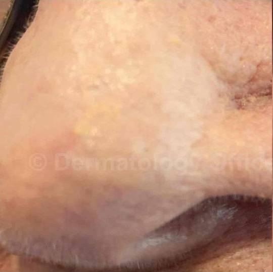 SRT-100 Before and After Case 21 Before