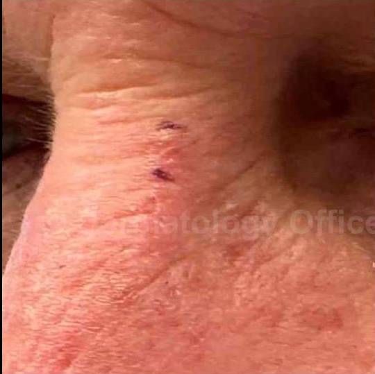 SRT-100 Before and After Case 23 Before