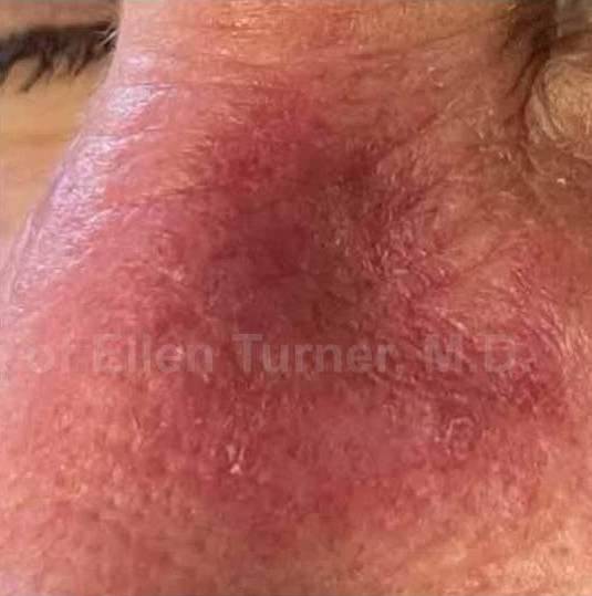 SRT-100 Before and After Case 23 After