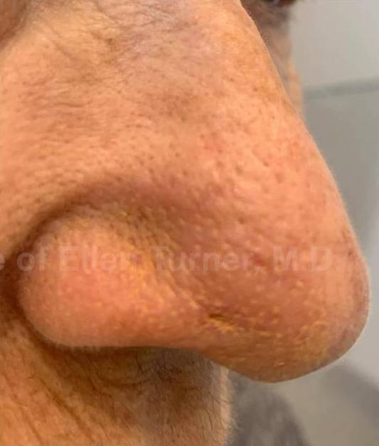 SRT-100 Before and After Case 24 After