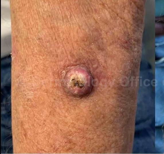 SRT-100 Before and After Case 26 Before