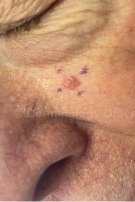 SRT-100 Before and After Case 27 Before