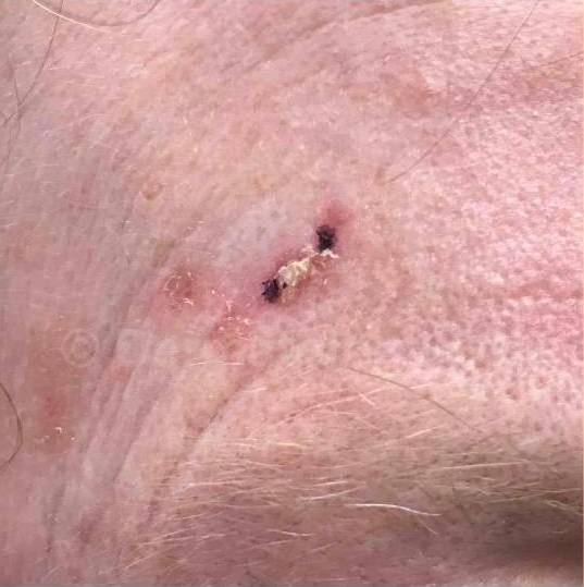 SRT-100 Before and After Case 28 Before