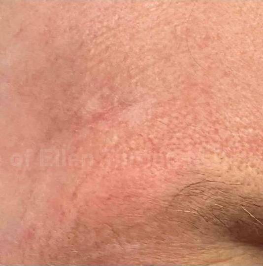 SRT-100 Before and After Case 28 After