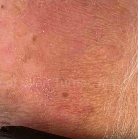 SRT-100 Before and After Case 30 After