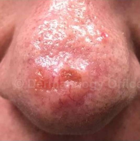 SRT-100 Before and After Case 34 Before