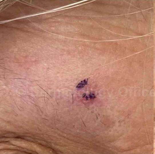 SRT-100 Before and After Case 35 Before