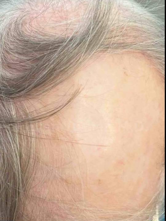 SRT-100 Before and After Case 36 After