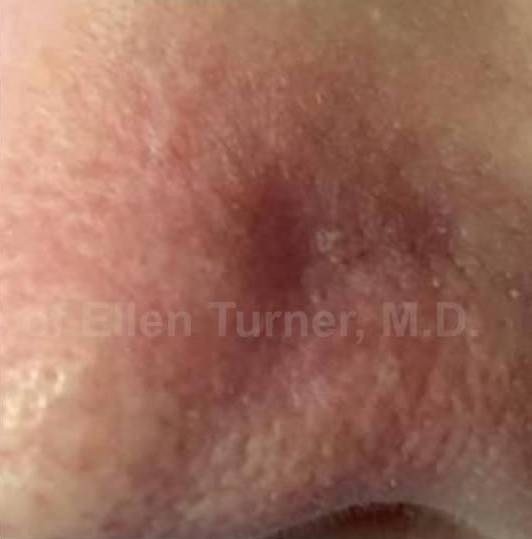 SRT-100 Before and After Case 37 After