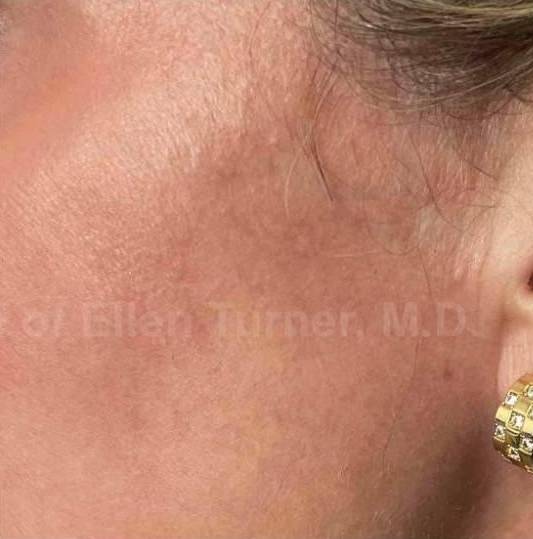 SRT-100 Before and After Case 38 After