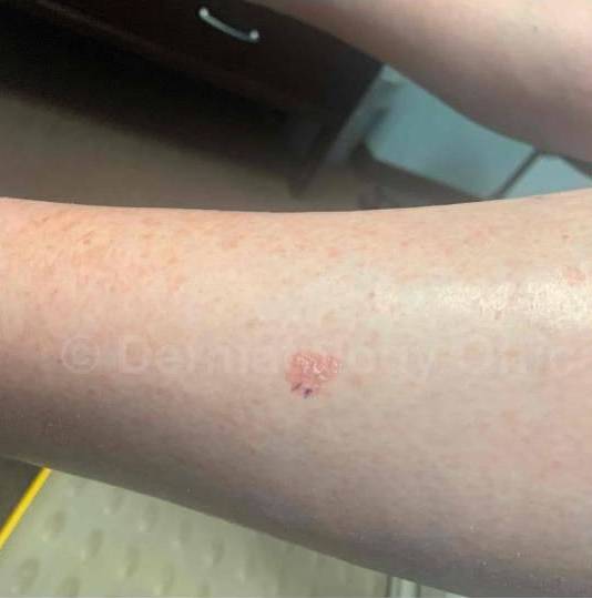 SRT-100 Before and After Case 39 Before