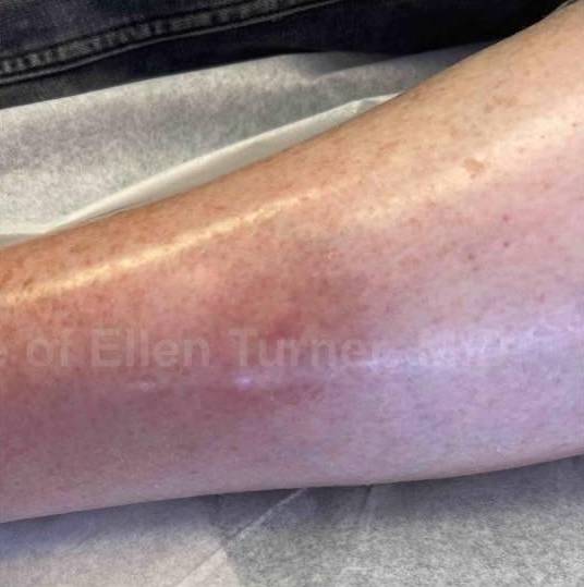 SRT-100 Before and After Case 39 After