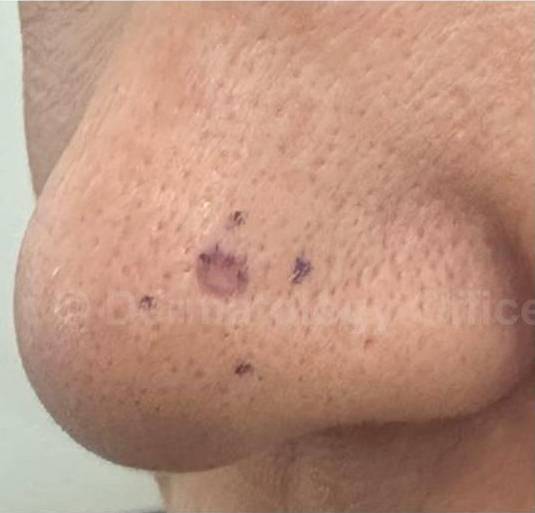 SRT-100 Before and After Case 32 Before