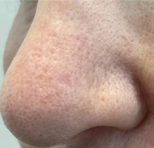 SRT-100 Before and After Case 32 After