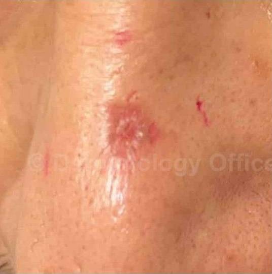 SRT-100 Before and After Case 33 Before