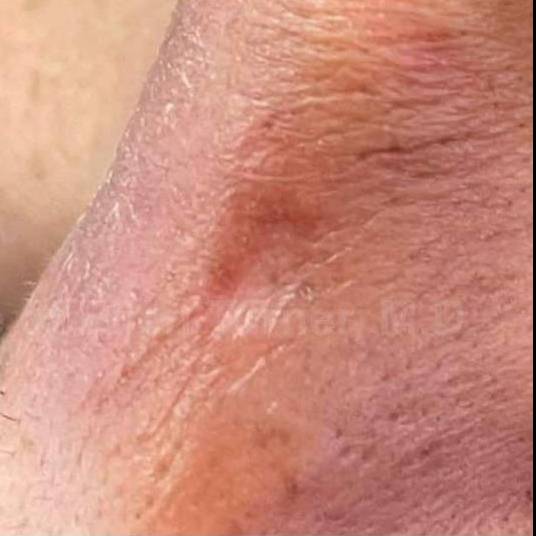 SRT-100 Before and After Case 33 After