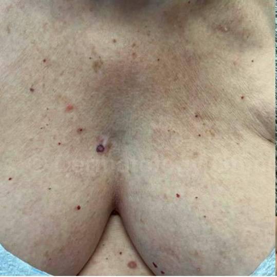 SRT-100 Before and After Case 48 Before