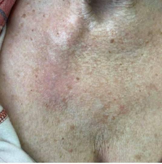 SRT-100 Before and After Case 49 After