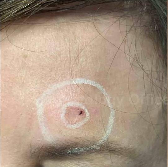 SRT-100 Before and After Case 50 Before