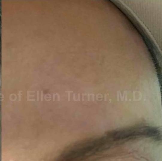 SRT-100 Before and After Case 50 After