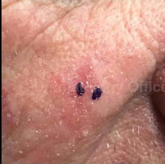 SRT-100 Before and After Case 40 Before