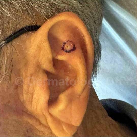 SRT-100 Before and After Case 41 Before