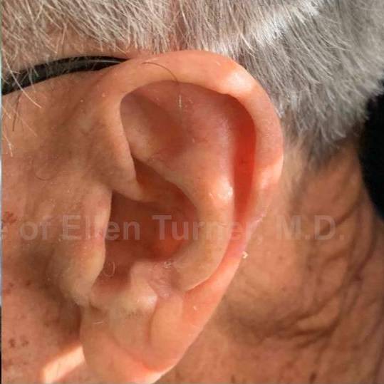 SRT-100 Before and After Case 41 After