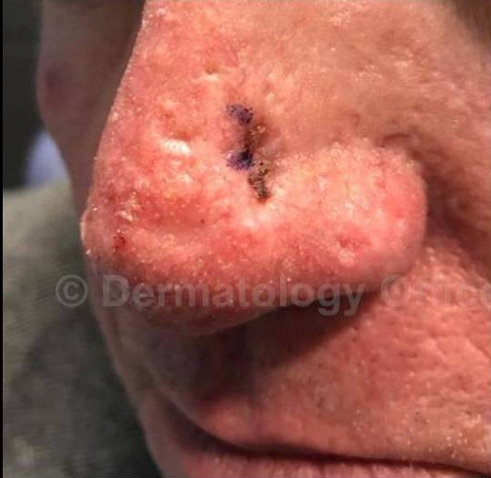 SRT-100 Before and After Case 42 Before