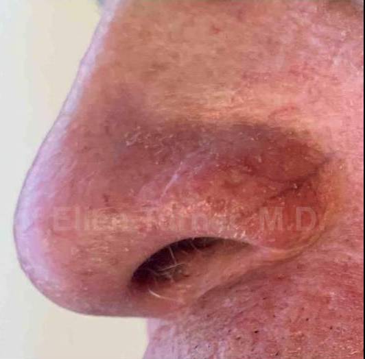 SRT-100 Before and After Case 42 After