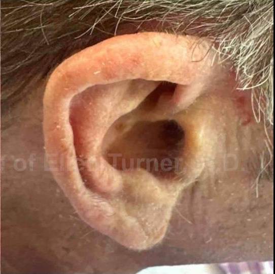 SRT-100 Before and After Case 43 After