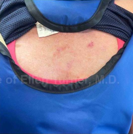 SRT-100 Before and After Case 44 After