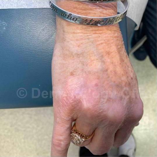 SRT-100 Before and After Case 46 Before