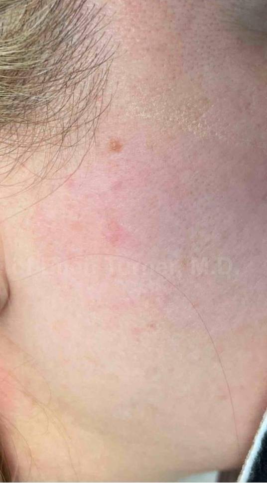 SRT-100 Before and After Case 85 After