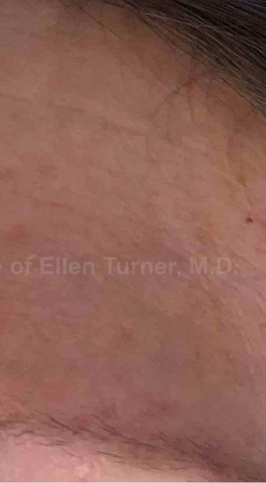 SRT-100 Before and After Case 83 After