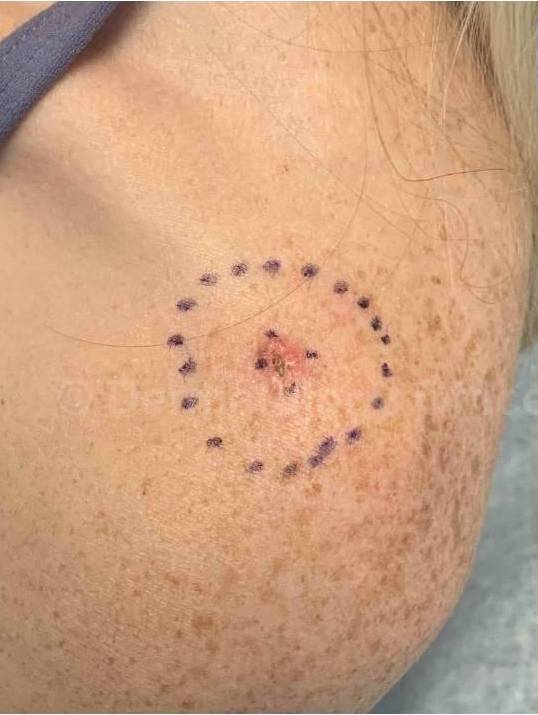 SRT-100 Before and After Case 82 Before