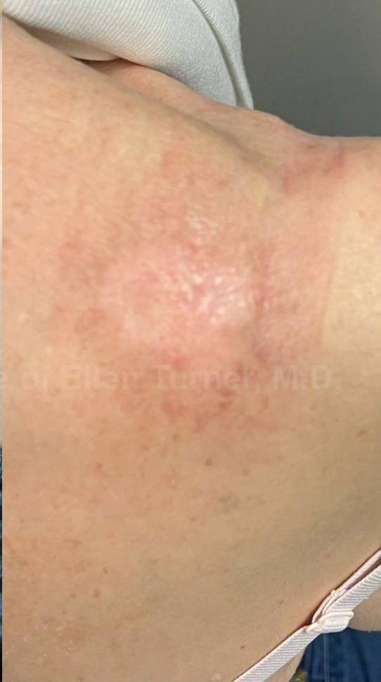 SRT-100 Before and After Case 81 After