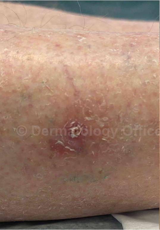 SRT-100 Before and After Case 80 Before