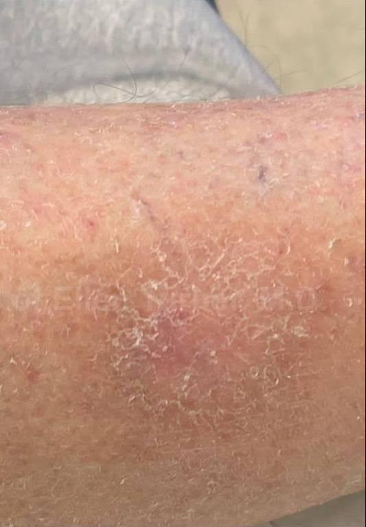 SRT-100 Before and After Case 80 After