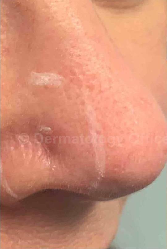 SRT-100 Before and After Case 70 Before