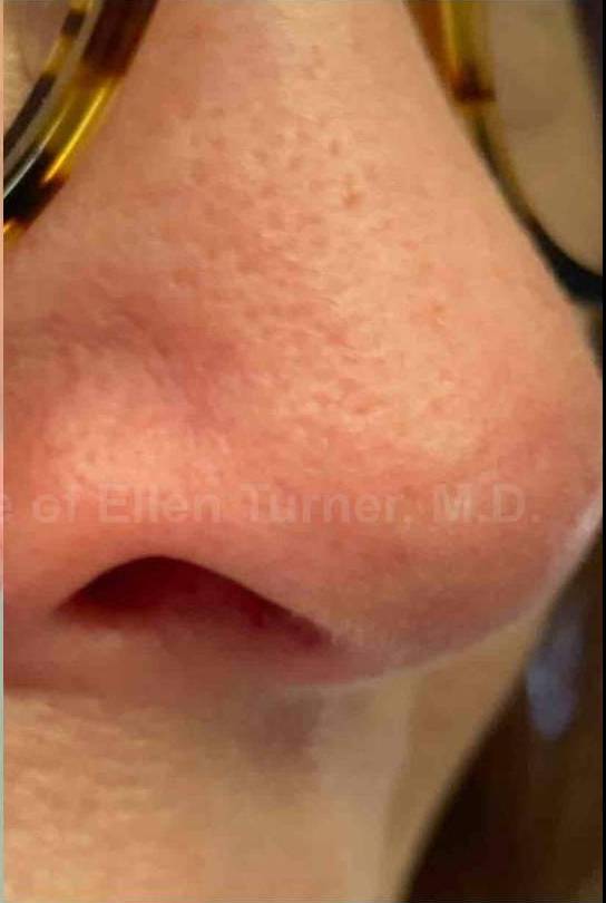 SRT-100 Before and After Case 70 After