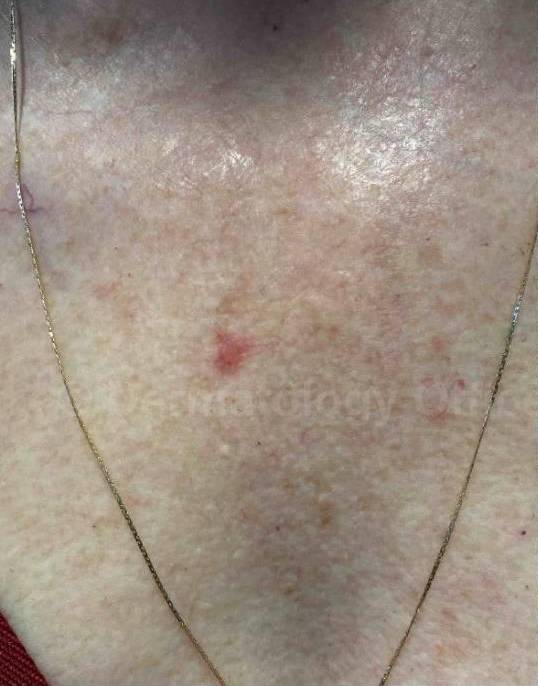 SRT-100 Before and After Case 77 Before