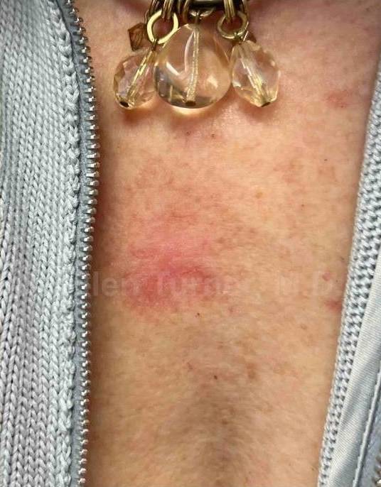 SRT-100 Before and After Case 77 After