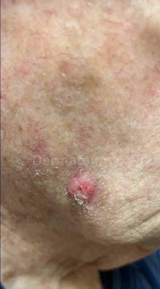 SRT-100 Before and After Case 76 Before