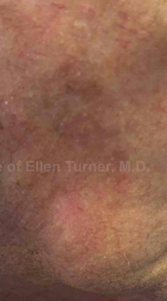 SRT-100 Before and After Case 76 After