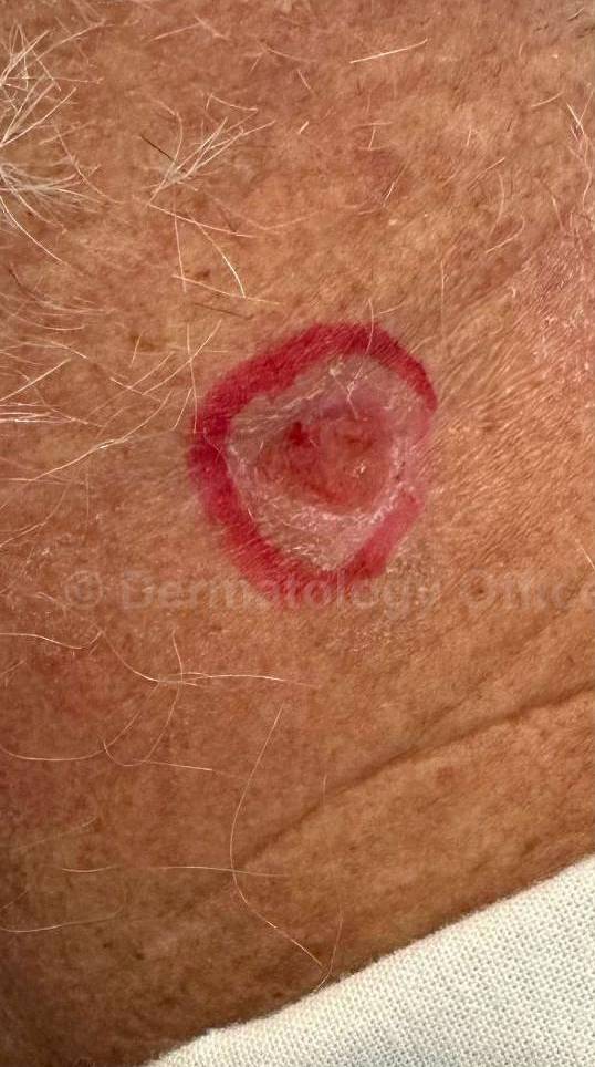 SRT-100 Before and After Case 75 Before